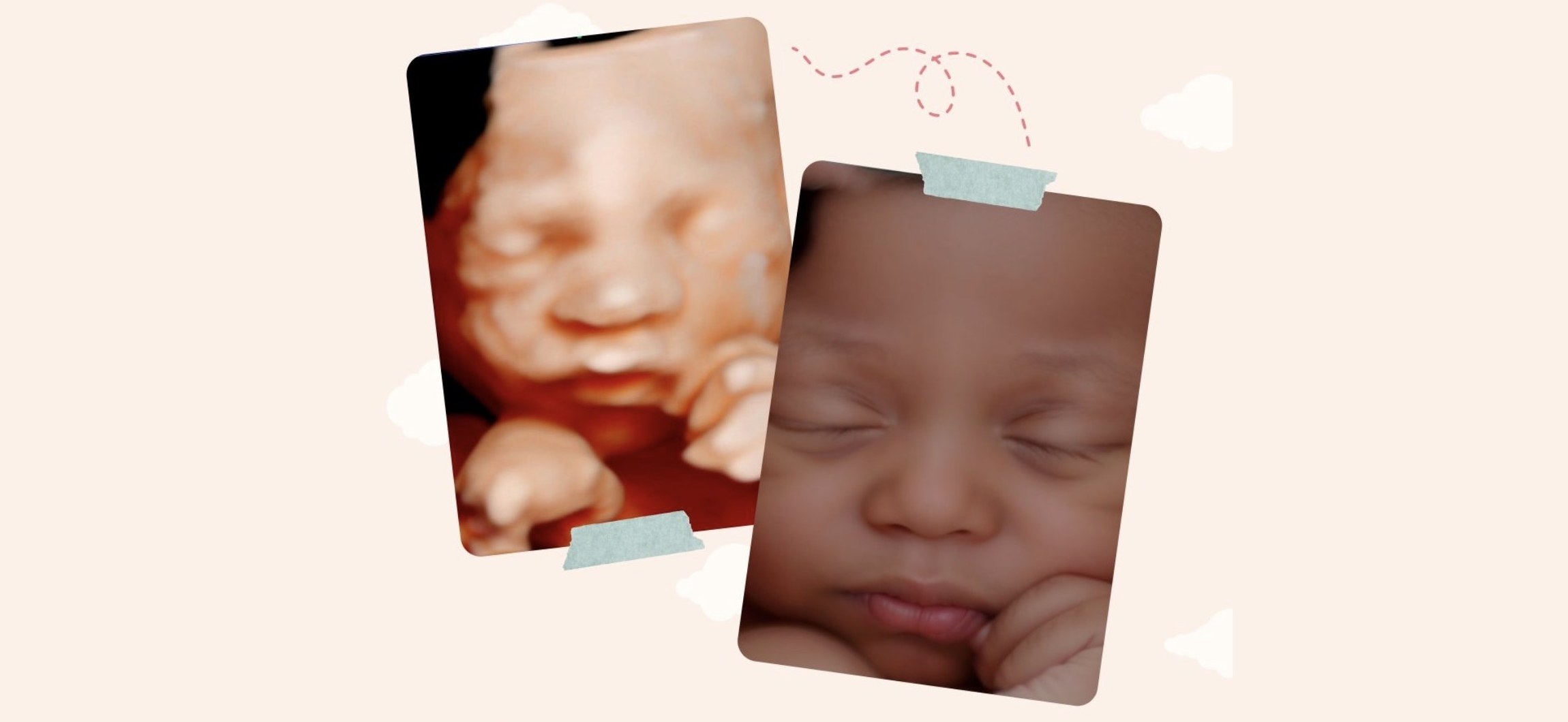 Imagem digital pré-natal ao lado da fotografia de um recém-nascido a dormir